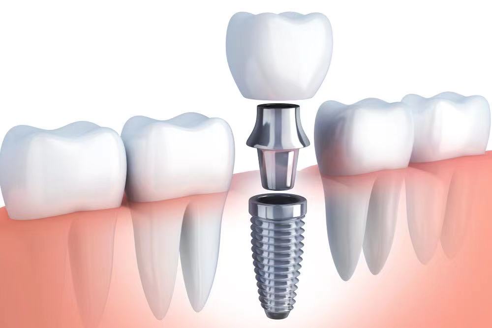 Do you know anything about dental implants?