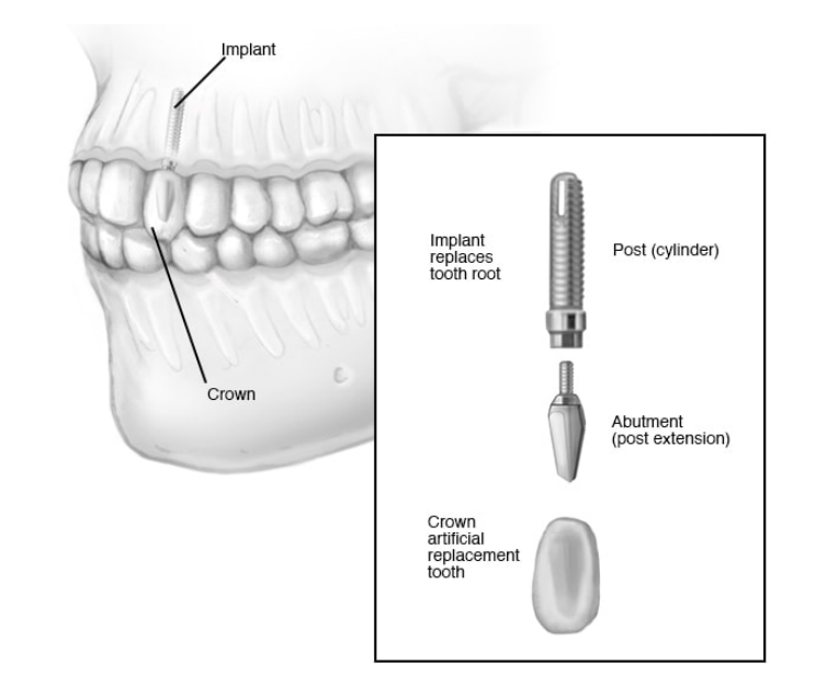 How is dental implant surgery performed?
