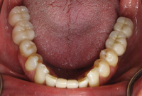 //iirorwxhloqjli5p.ldycdn.com/cloud/liBpkKloljSRilijmqkljq/anatotemp-healing-abutment.jpg