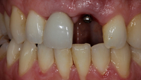 //iirorwxhloqjli5p.ldycdn.com/cloud/liBpkKloljSRillinilijo/implant-abutment-screw-retrieval-straumann.jpg