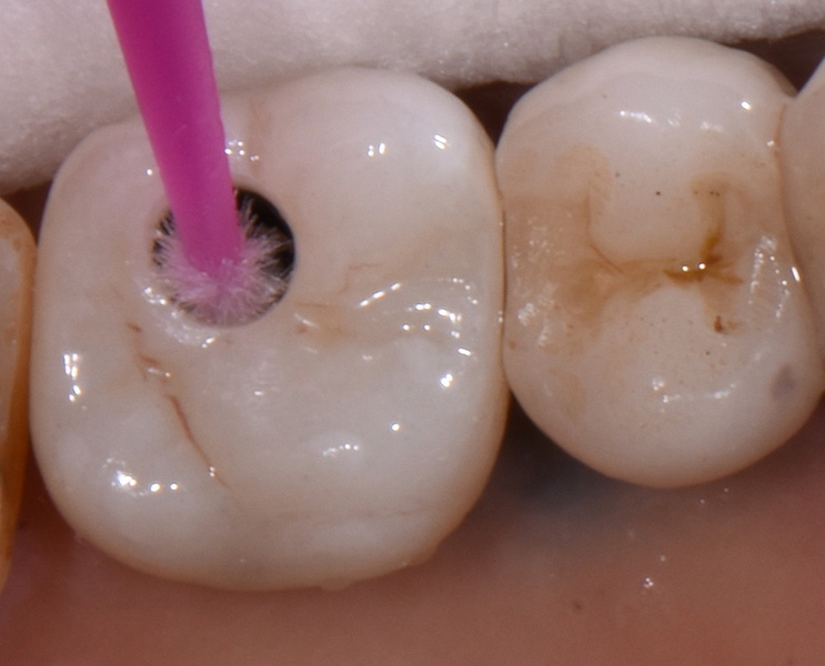 How To Measure Implant Abutment Screw Dimensions Accurately?