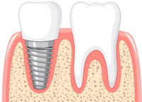 //iirorwxhloqjli5p.ldycdn.com/cloud/liBpkKloljSRilnjmniljq/does-a-dental-implant-eventually-fuse-with-bone.jpg