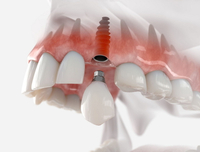 //iirorwxhloqjli5p.ldycdn.com/cloud/liBpkKloljSRilorioijjo/do-i-have-enough-gum-around-my-molar-dental-implant.jpg