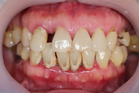 //iirorwxhloqjli5p.ldycdn.com/cloud/liBpkKloljSRilorrqoqjq/do-i-have-to-take-antibiotics-after-a-dental-implant.jpg