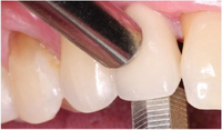 //iirorwxhloqjli5p.ldycdn.com/cloud/liBpkKloljSRilqiopkijq/nobel-abutment-screw-retrieval-kit.jpg