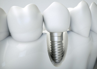 //iirorwxhloqjli5p.ldycdn.com/cloud/liBpkKloljSRilqrrrmrjo/do-it-yourself-dental-implant-eliminate-an-infection.jpg