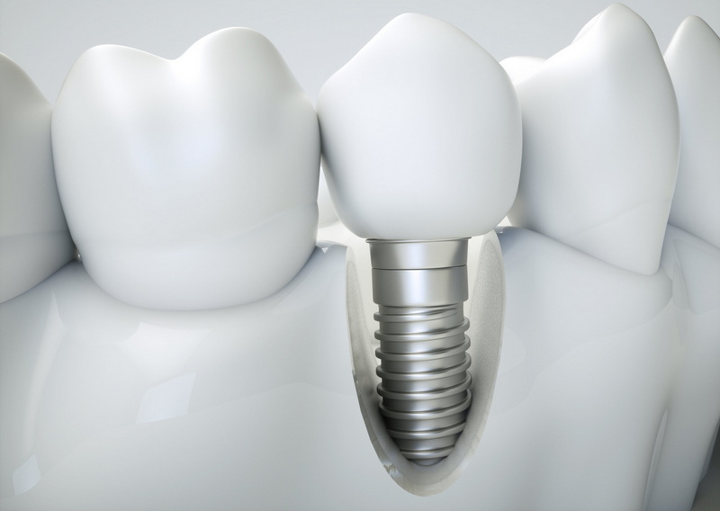 Do It Yourself Dental Implant Eliminate An Infection?