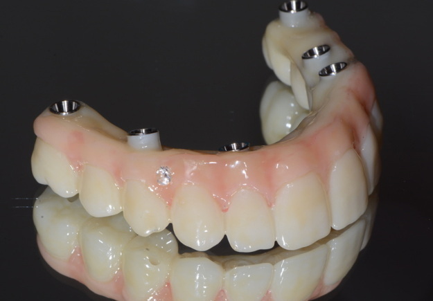 how much is a full arch dental implant