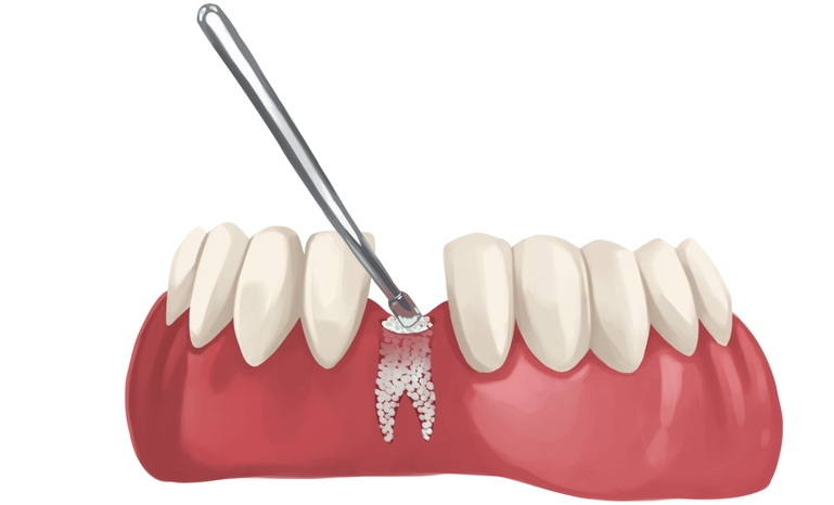 How Much Is Bone Graft for Dental Implant?