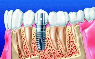 what to expect after dental implant surgery_15