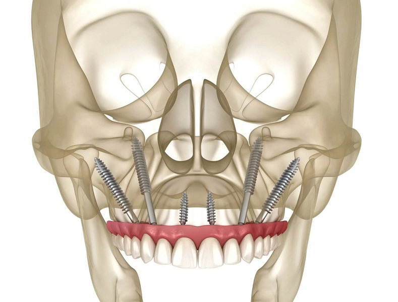  use medisave for dental implant_1