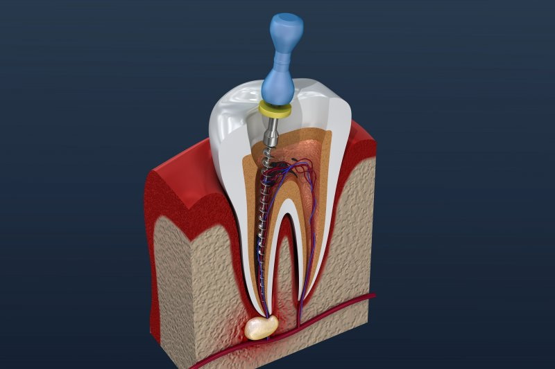 kiss after dental implant surgery_1