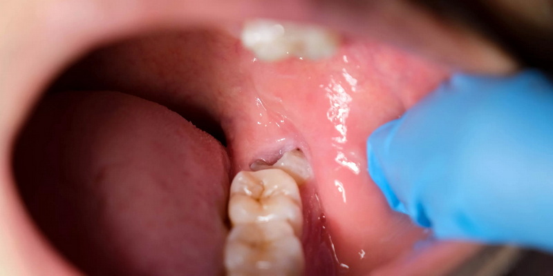 do you need anesthesia for dental implant_2