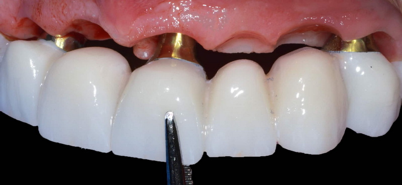 Are Dental Implant Covered by Insurance?