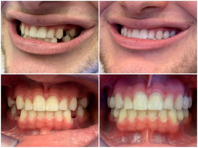  dental implant be done in one day_3