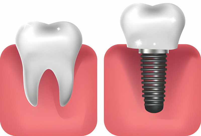 a loose dental implant be repaired_2