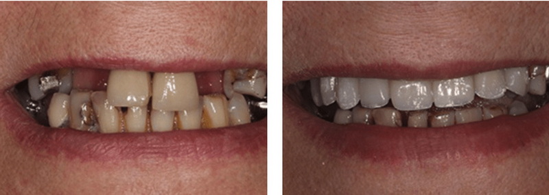 get a dental implant 2 years after extraction_2