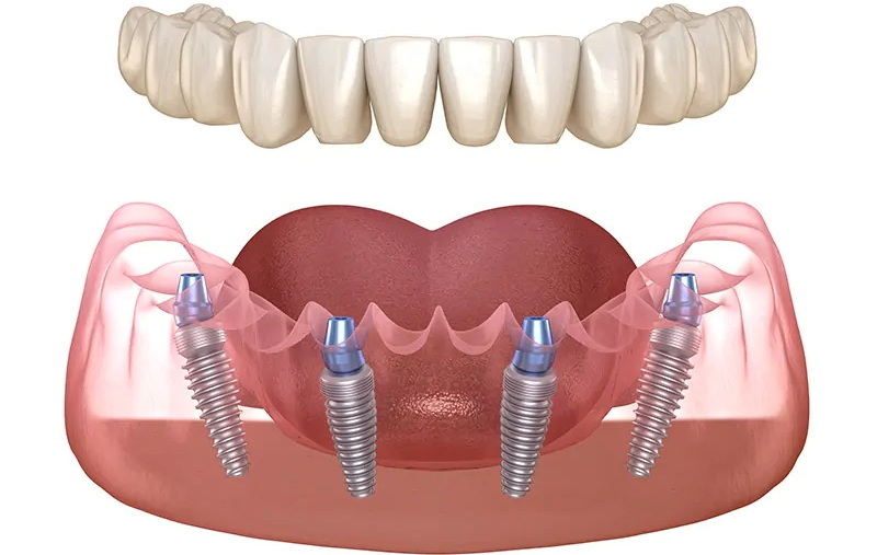 can go to canada for a full dental implant_3