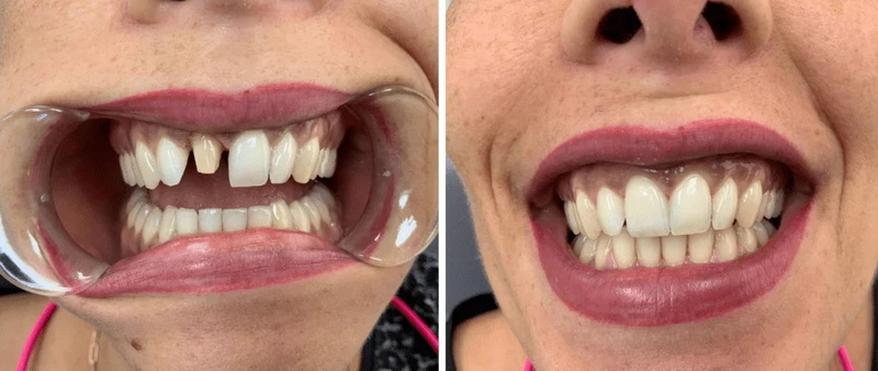 What Is The Recovery Time After Getting A Dental Implant_4