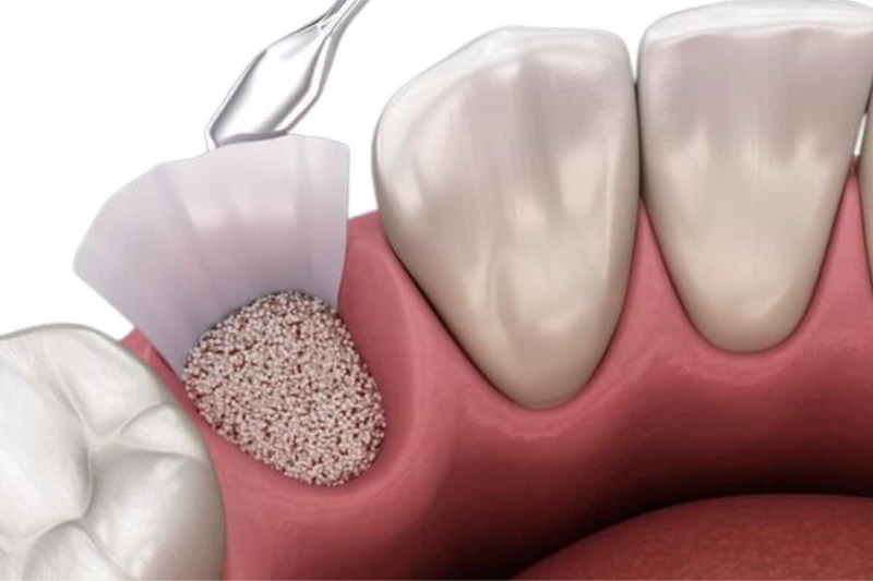 what happens when a dental implant is loose_2