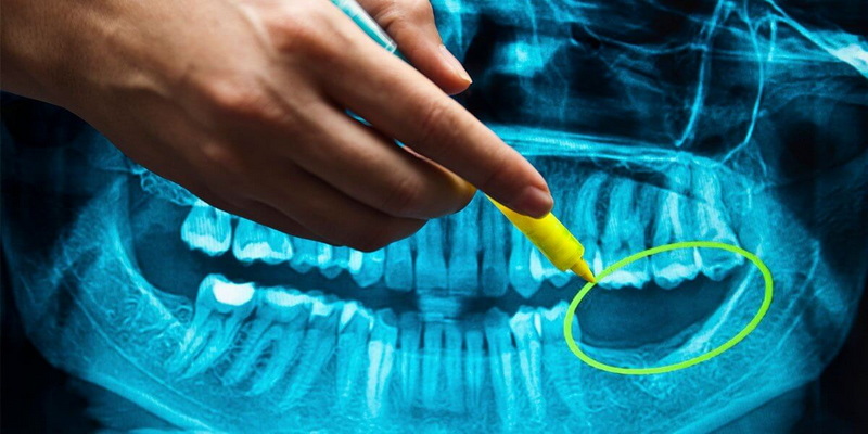 What Is The Procedure for A Dental Implant?