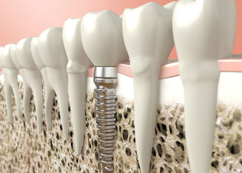  if dental implant is infected_2