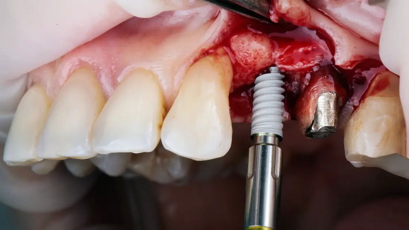 What's A Mini Dental Implant?