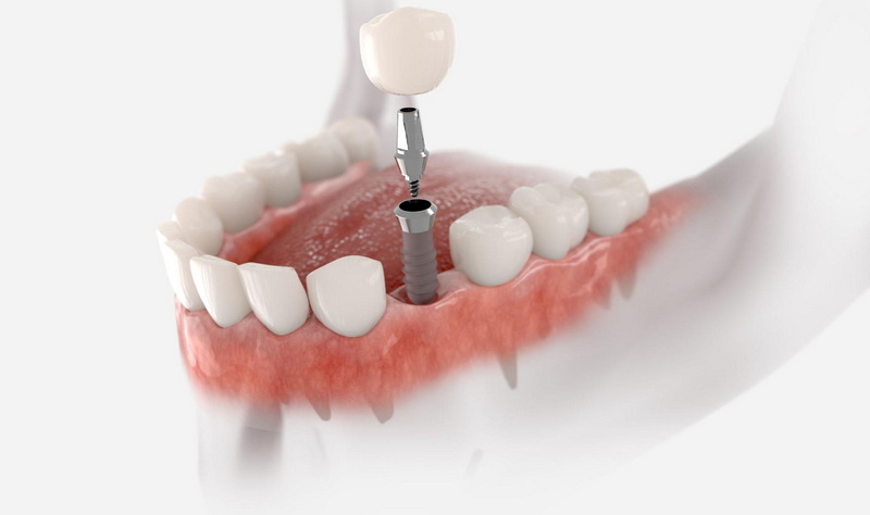 What Is Surgical Guide for Dental Implant?