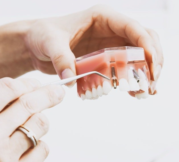 the best dental implant brand_2