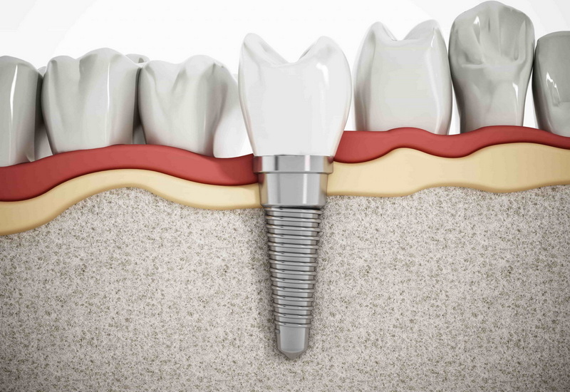 What Is The Best Dental Implant?