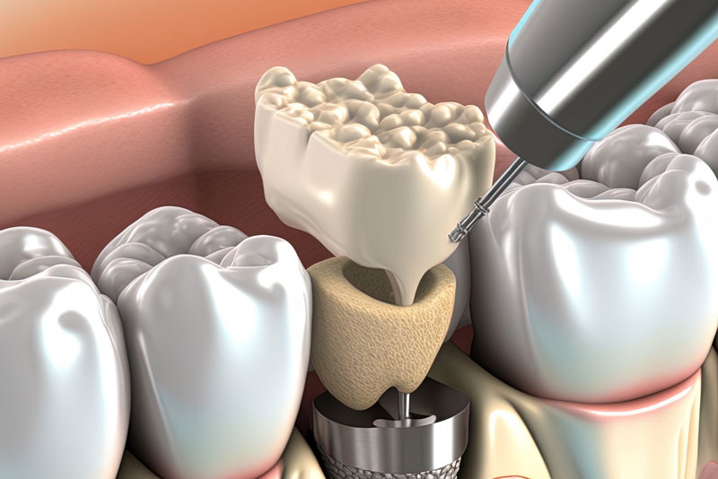 What Is A Dental Implant Torque Test?