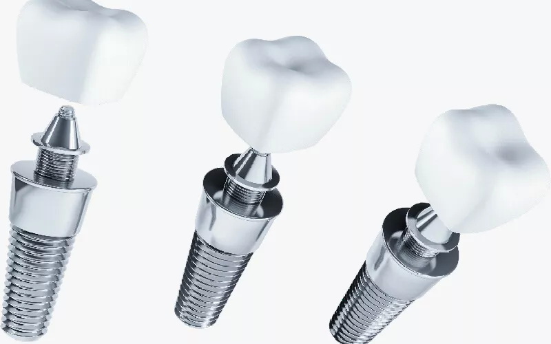 what is involved in a dental implant_1