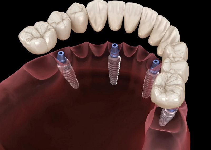 What Foods To Avoid After Dental Implant?