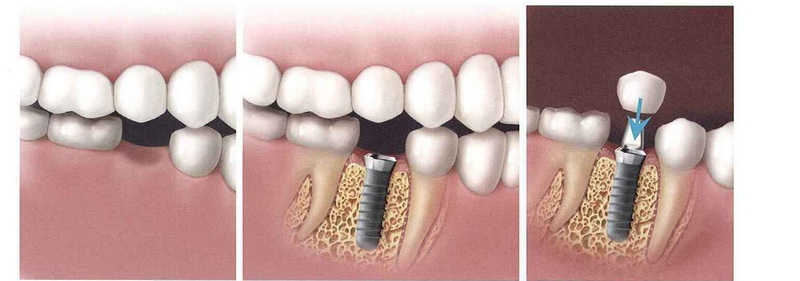 what happens if dental implant gets infected_3