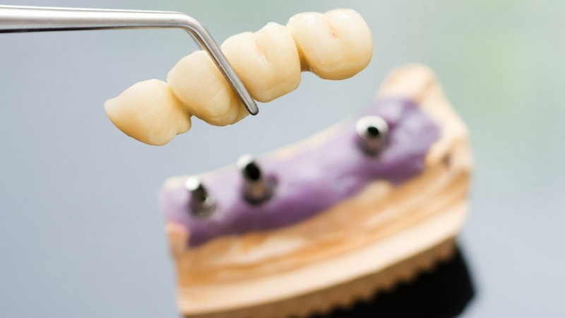 dental implant abutment look like_1