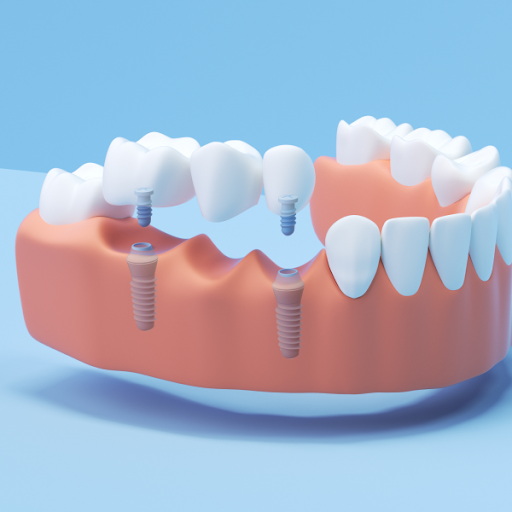 what are the side effects of a dental implant_2