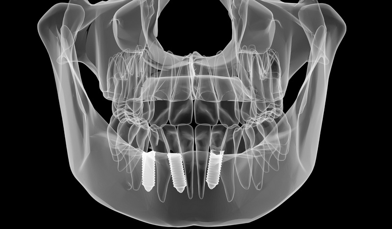 What Does A Dental Implant Involve?