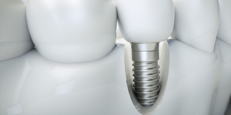 What Age Can You Get A Dental Implant?