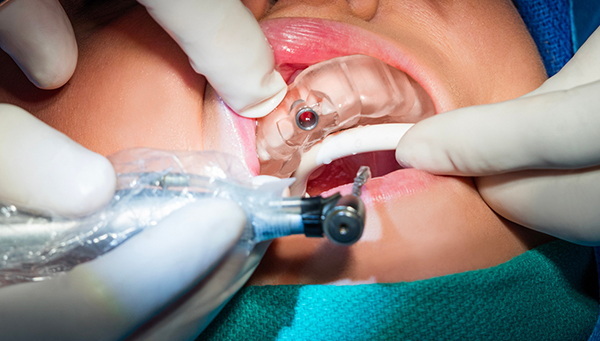 should my dental implant wiggle_2