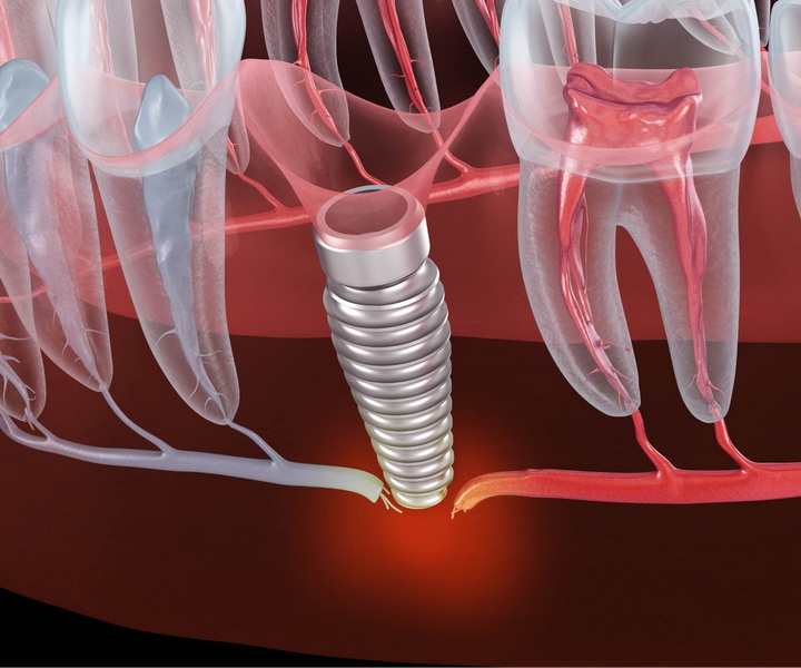 a failing dental implant_3