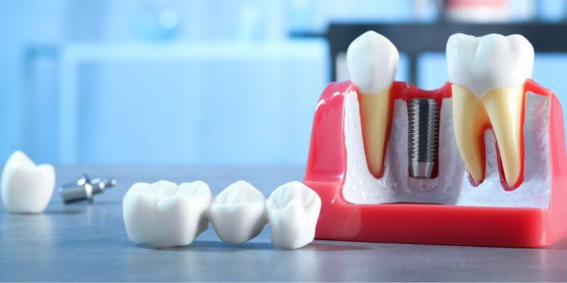 does a loose dental implant hurt_3
