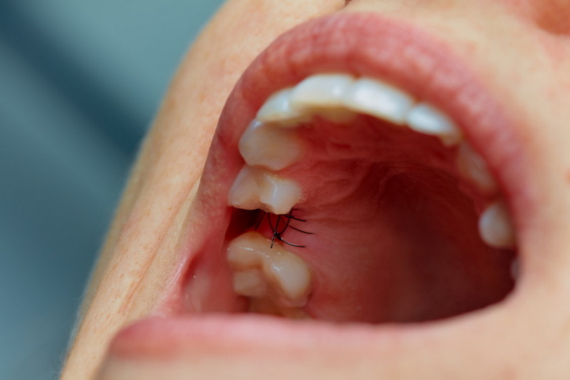 How Long Does The Pain Last After A Dental Implant?