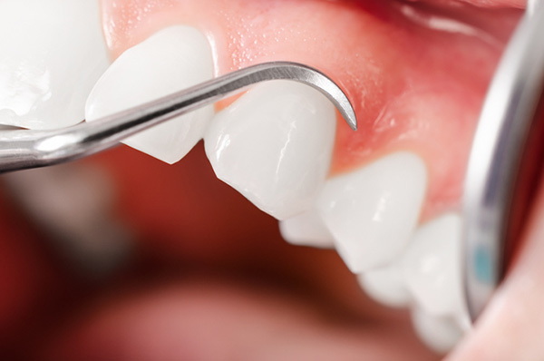 how long does dental implant healing take_02