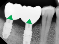 //iirorwxhloqjli5p.ldycdn.com/cloud/liBpkKloljSRrlinoqrpjq/abutment-screw-loosening-types.jpg