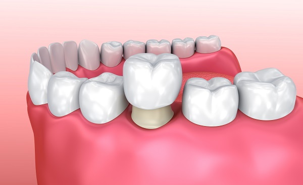 what happens after a dental implant