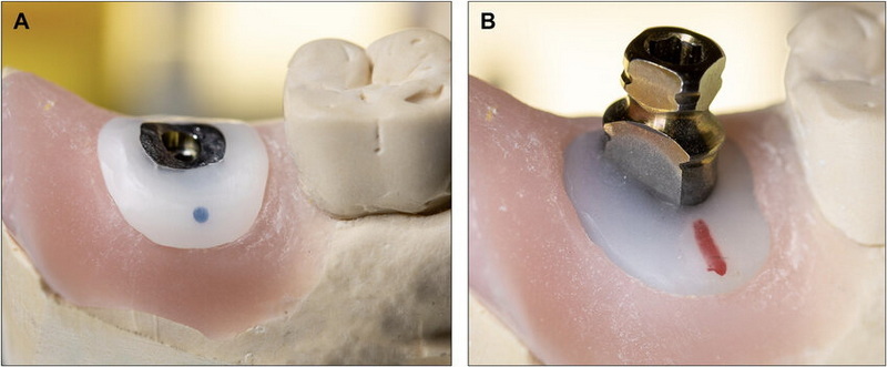 can you brush your teeth after dental implant