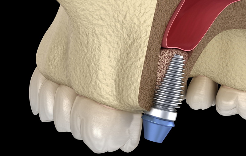 can dental implant claim medisave