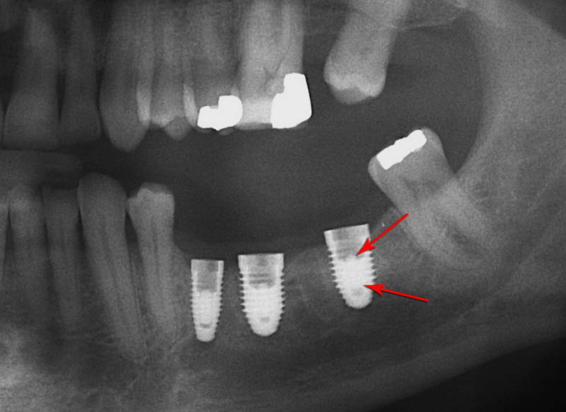 dental code for abutment screw removal