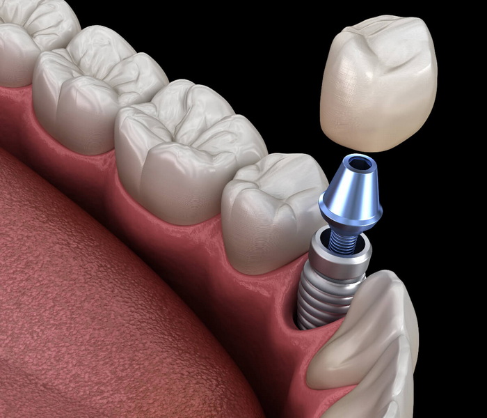 can you be reimbursed for failed dental implant