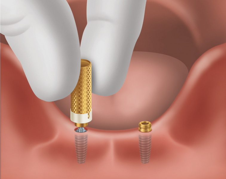 dental abutment in spanish